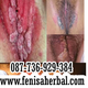 Illustration for article titled Tanda-Tanda Kutil Kelamin Condyloma Acuminata Di Bibir Memek
